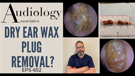 DRY EAR WAX PLUG REMOVAL - EP652 - YouTube