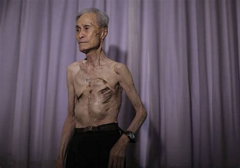 Nagasaki atomic bomb survivor shows his scars | World News – India TV