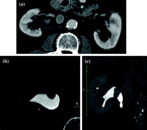 CT Urography | Radiology Key