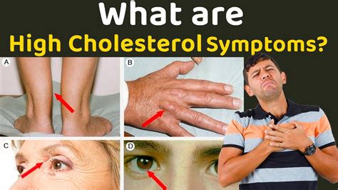 High Cholesterol Symptoms