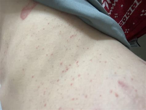 Itchy rash after surgery, not allergic contact dermatitis : r ...