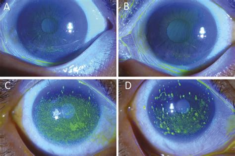 Prognostic factors for the clinical severity of keratoconjunctivitis ...