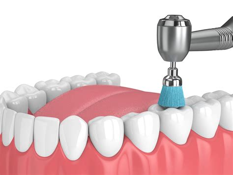 Everything You Need To Know About Tooth Polishing