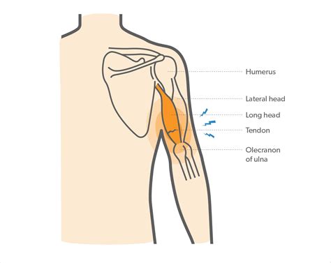 What is a Triceps Tendon Rupture & How to Recover? - Upswing Health