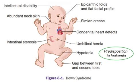 what is the life expectancy of someone with edwards syndrome ...