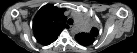 Percutaneous Biopsy – Undergraduate Diagnostic Imaging Fundamentals