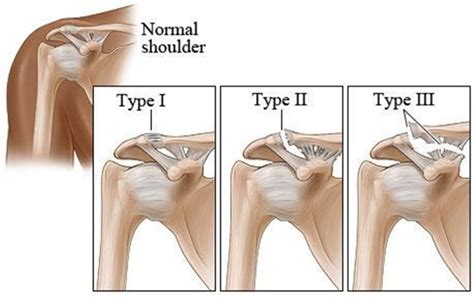 Shoulder Sprains - Lawrence Li, MD - Orthopedic & Shoulder Center