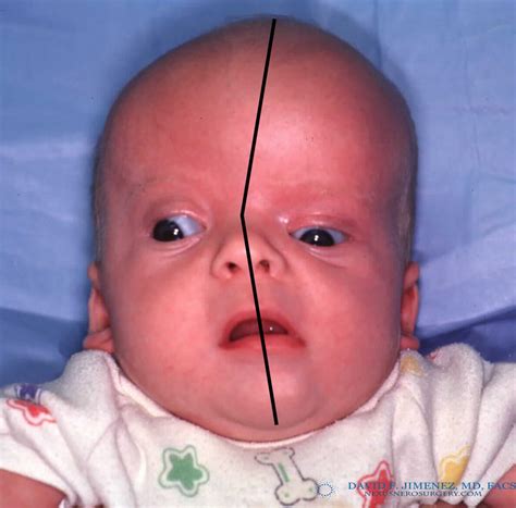 Coronal Synostosis Facts and Photos | Craniosynostosis