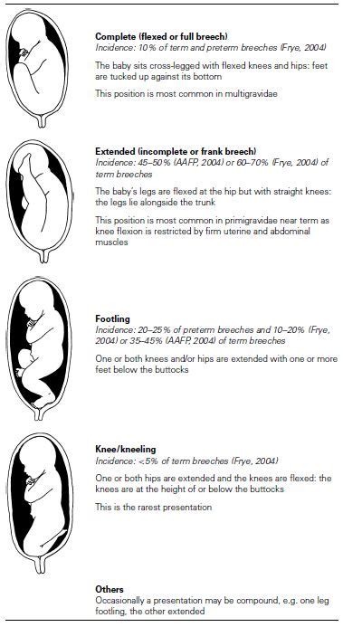 Breech birth | Nurse Key