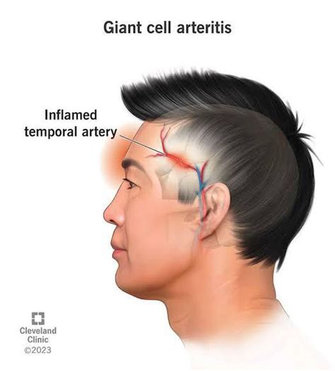 Arteritis - MEDizzy