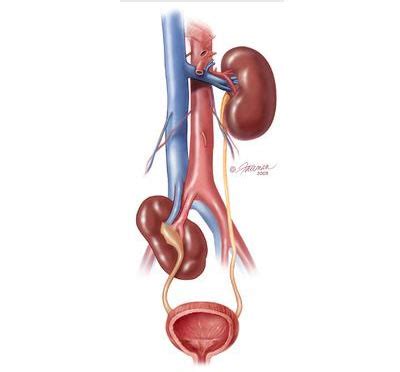 Ectopic Kidney: Symptoms, Diagnosis & Treatment - Urology Care Foundation