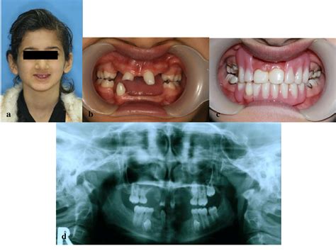 Ectodermal Dysplasia Teeth