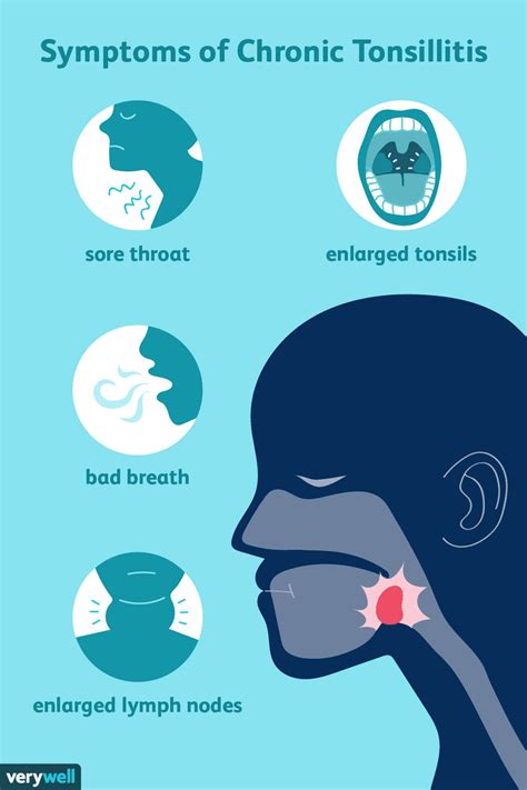 Chronic and Recurrent Tonsillitis: What to Know