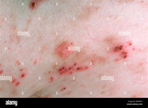 PRURITIC RASH Stock Photo, Royalty Free Image: 31078449 - Alamy