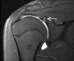 Mri Shoulder Labrum Tear