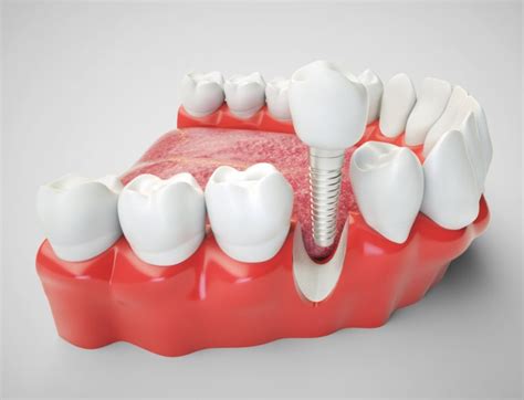 How Valuable Metals are Used in Medicine - The Hominid Post