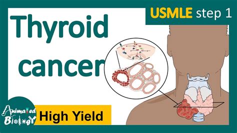 Thyroid cancer | (Papillary, Follicular, Medullary & Anaplastic) | Symptoms, Diagnosis ...