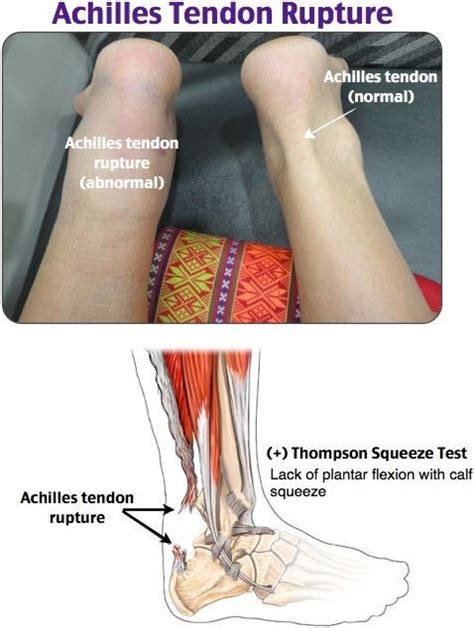 How Long Does An Achilles Tear Take To Heal - Margaret Greene Kapsels