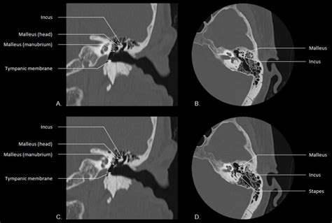 Middle ear anatomy: Ossicles and tympanic membrane in coronal (A, C ...