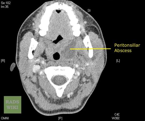 Peritonsillar Abscess Uvula Deviation