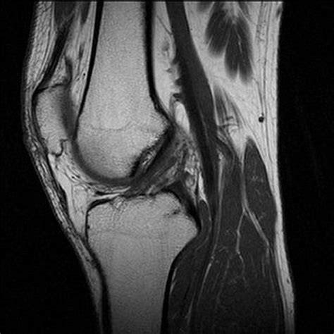 Knee Injuries: Knee Injuries Mri Pictures