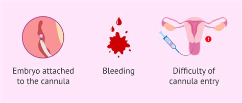 Possible risks in embryo transfer