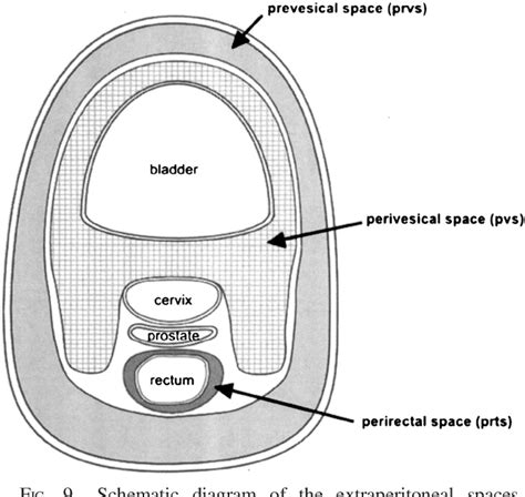 Figure 9 from Surgical Anatomy of the Retroperitoneal Spaces Part II: The Architecture of the ...