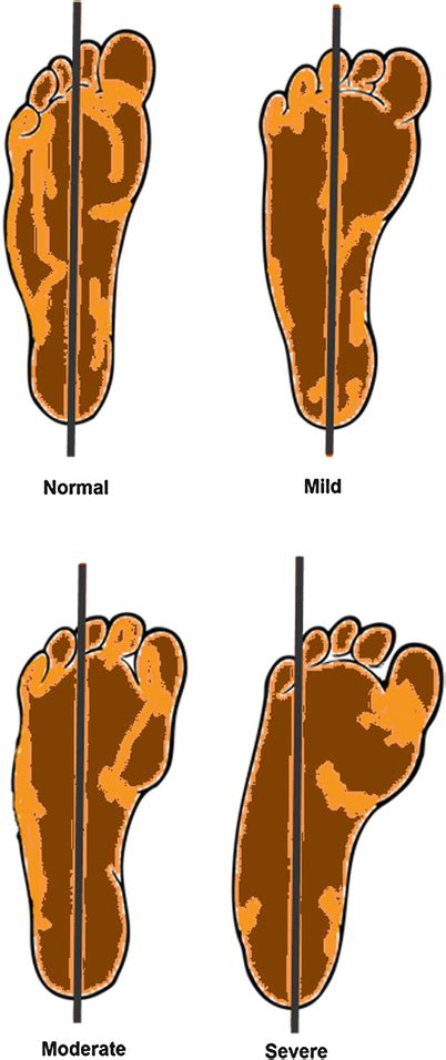 Evidence-Based Treatment for Metatarsus Adductus | Musculoskeletal Key