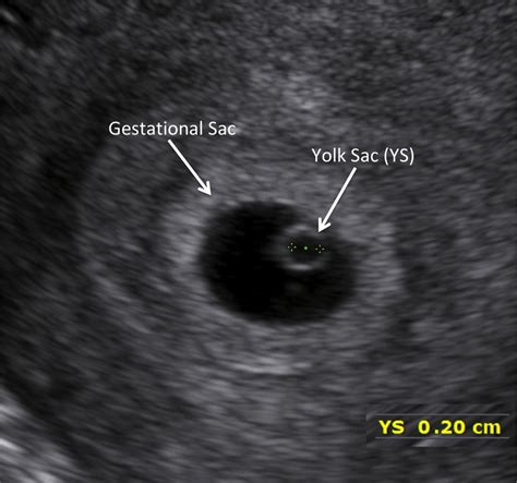 Yolk Sac Measurement Ultrasound