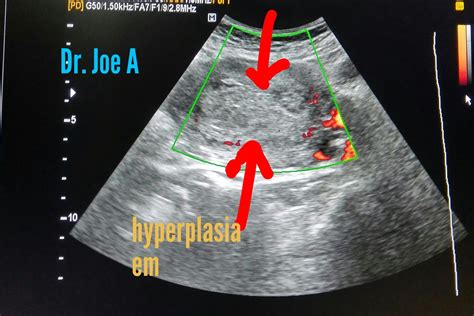 Ultrasound imaging: Cystic-endometrial-hyperplasia-3D ultrasound