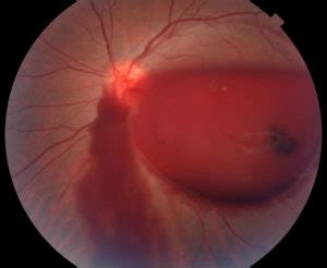 vitreous-hemorrhage - Retina Eya Care, P.C.