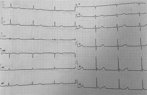 Electrocardiogram on admission. A small deflection ( J wave) at the end... | Download Scientific ...