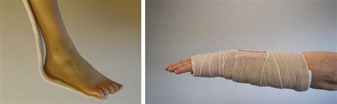 Cuidado de yesos y férula (Care of Casts and Splints) - OrthoInfo - AAOS