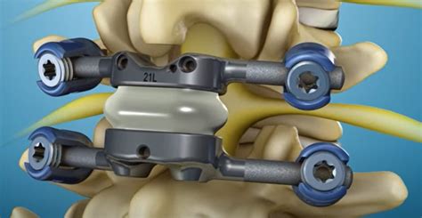 Premia Spine TOPS System Achieves FDA Premarket Approval with Superiority-to-Fusion Label