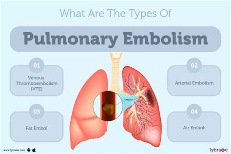 Pulmonary Embolism Treatment