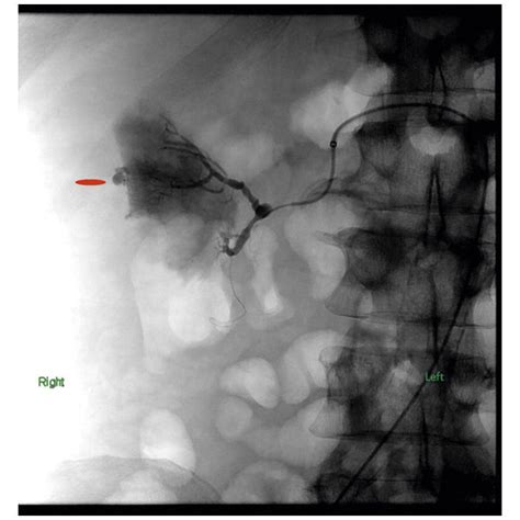 Selective right renal angiogram showing renal artery branch aneurysm... | Download Scientific ...