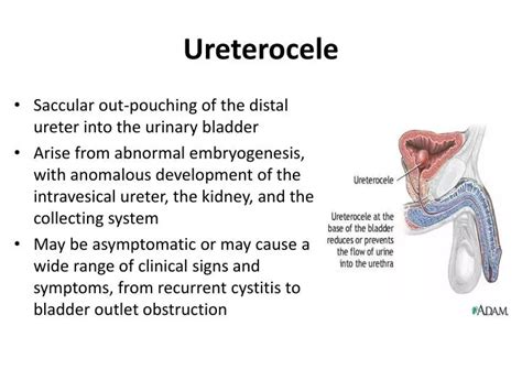 PPT - Ureterocele PowerPoint Presentation, free download - ID:1722113