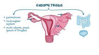 Boggy Uterus: What Is It, Causes, Treatment, and More | Osmosis