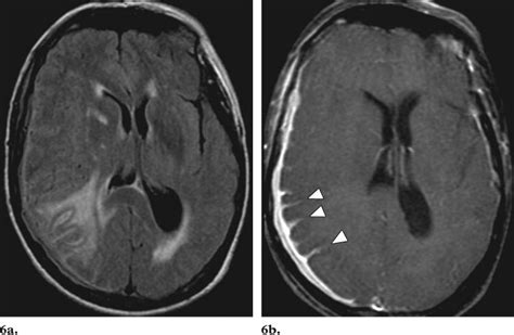 , 7. (6) Mixed pachymeningeal and leptomeningeal enhancement in dural... | Download Scientific ...