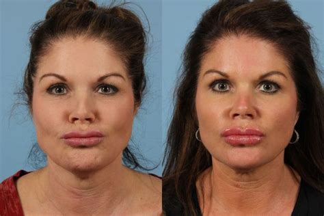 Conway - Cosmetic Injectables & Fillers - Before and After Gallery