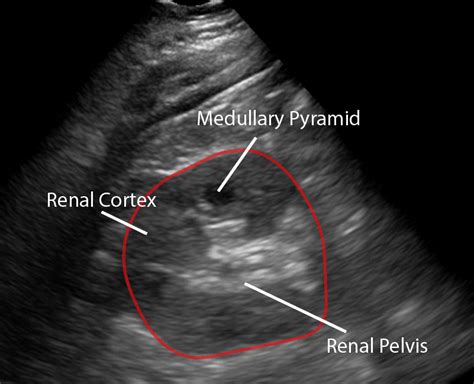 Normal Kidney Ultrasound