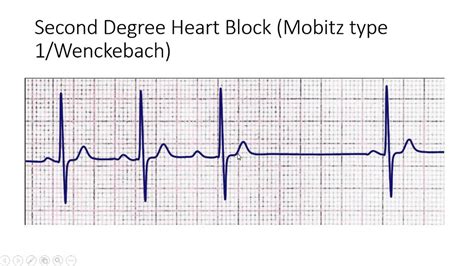 Image Gallery heart block mobitz i