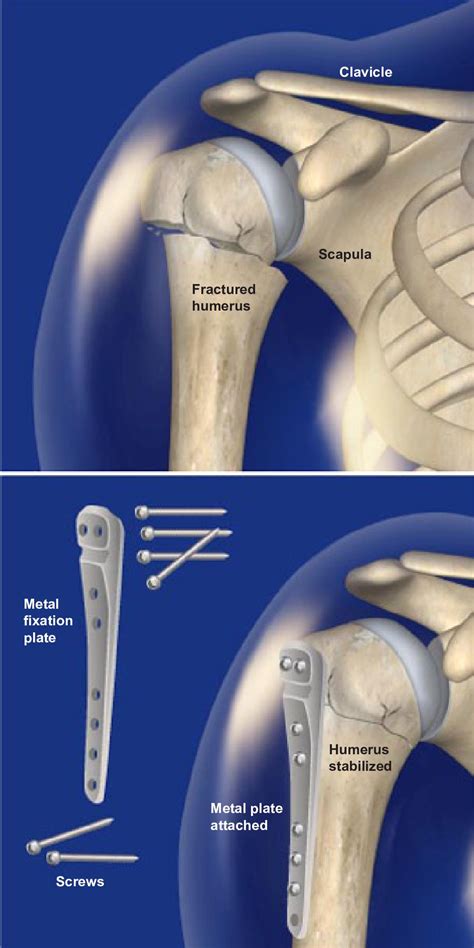 How Proximal Humerus Fractures Are Treated Humerus Fracture Rotator | Sexiz Pix