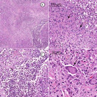 -Photomicrographs of a cervical lymph node biopsy sample. Lymphoid... | Download Scientific Diagram