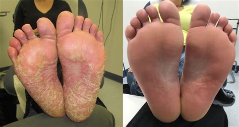 Before & After | DermAssociates Rockville | U.S. Dermatology Partners