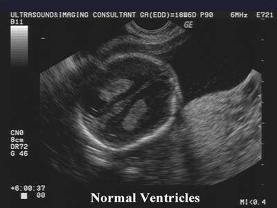 Fetal Hydrocephalus Ultrasound