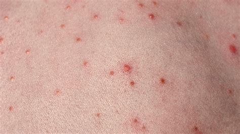 Pseudomonas Folliculitis