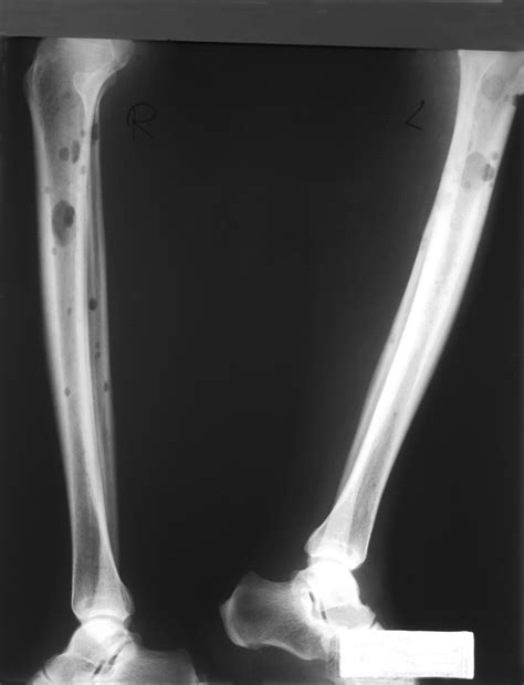 Multiple Myeloma Bone Lesions Treated in Phase 3 Study