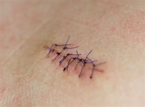 Surgical Mole Removal Stitches Stock Photo - Download Image Now - iStock