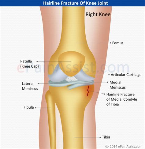 Hairline Fracture Of Knee Joint | Anatomi